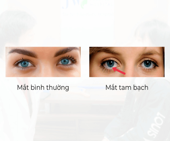 Mắt tam bạch là gì